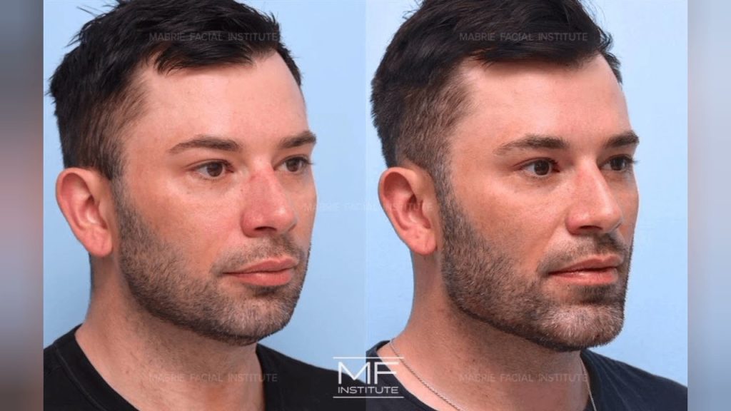Kybella Before and After: Patient Experiences and Success Stories